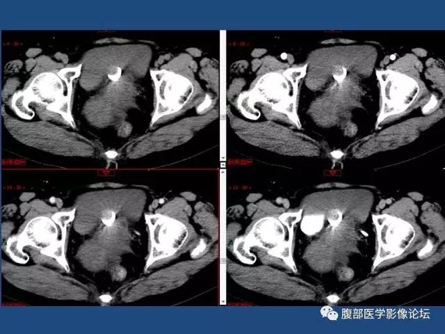 【病例】右侧卵巢卵泡膜细胞瘤1例CT影像表现