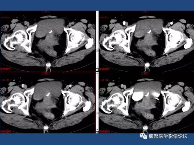 【病例】右侧卵巢卵泡膜细胞瘤1例CT影像表现