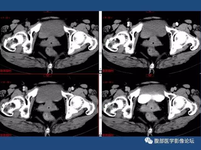【病例】右侧卵巢卵泡膜细胞瘤1例CT影像表现
