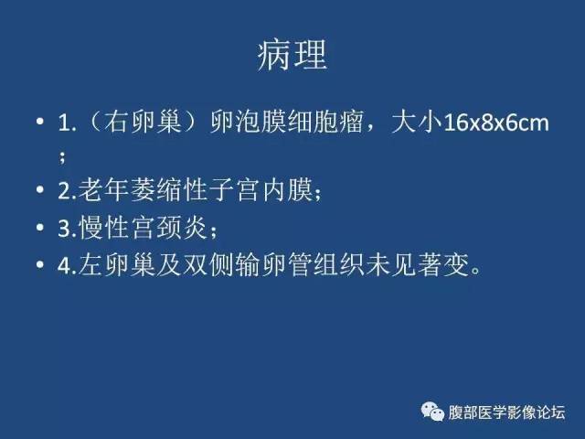【病例】右侧卵巢卵泡膜细胞瘤1例CT影像表现