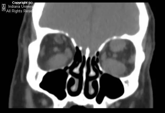 【病例】甲状腺眼病1例CT影像表现 【病例】甲状腺眼病1例CT影像表现