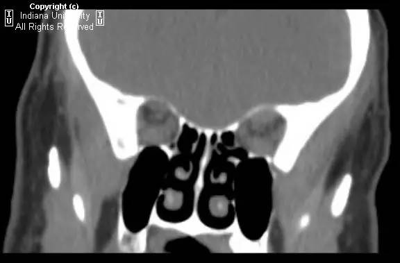 【病例】甲状腺眼病1例CT影像表现 【病例】甲状腺眼病1例CT影像表现