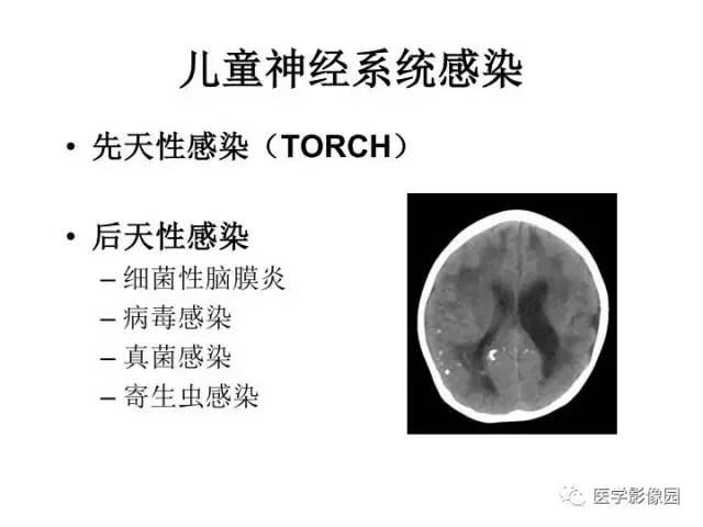 【PPT】婴幼儿中枢神经感染的CT/MRI特征分析