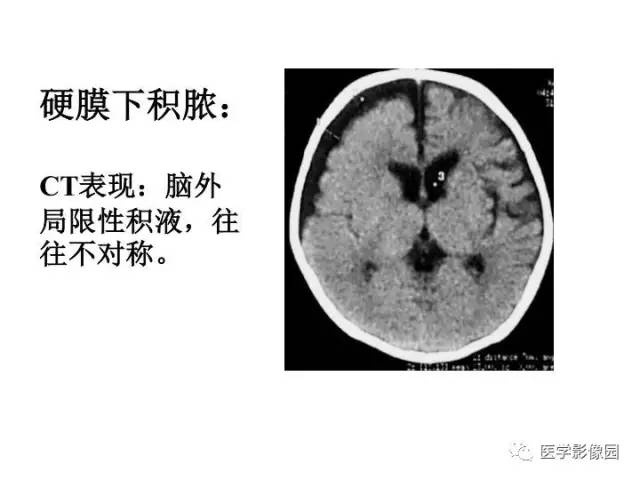 【PPT】婴幼儿中枢神经感染的CT/MRI特征分析