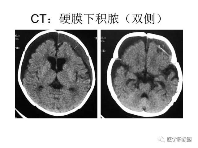 【PPT】婴幼儿中枢神经感染的CT/MRI特征分析