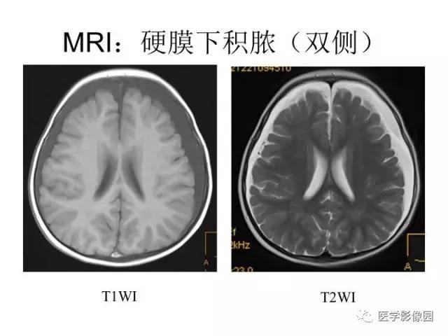 【PPT】婴幼儿中枢神经感染的CT/MRI特征分析