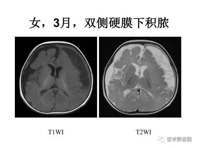 【PPT】婴幼儿中枢神经感染的CT/MRI特征分析