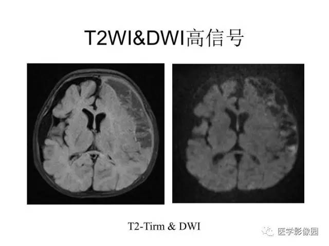 【PPT】婴幼儿中枢神经感染的CT/MRI特征分析