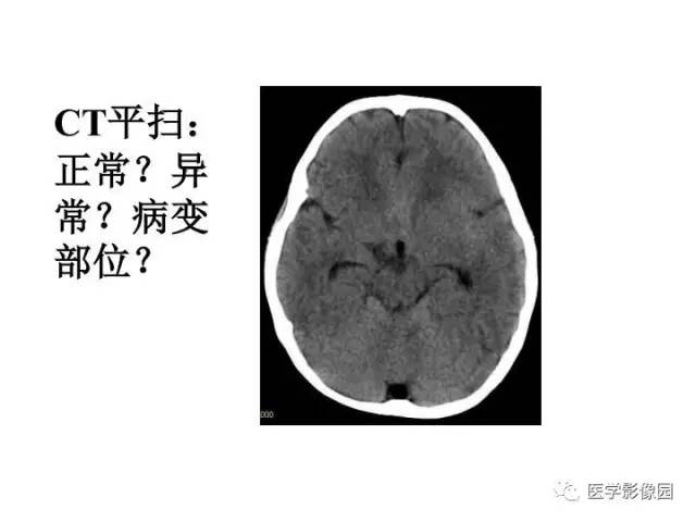 【PPT】婴幼儿中枢神经感染的CT/MRI特征分析