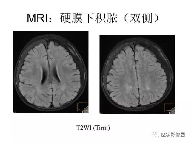 【PPT】婴幼儿中枢神经感染的CT/MRI特征分析
