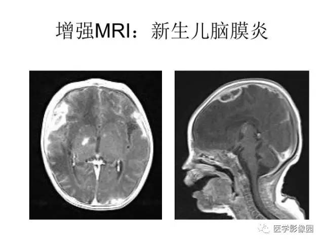 【PPT】婴幼儿中枢神经感染的CT/MRI特征分析