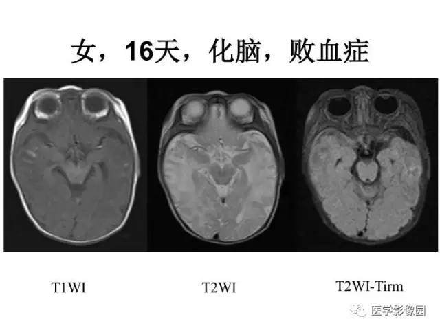 【PPT】婴幼儿中枢神经感染的CT/MRI特征分析