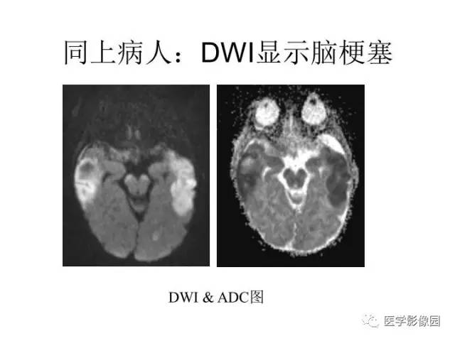 【PPT】婴幼儿中枢神经感染的CT/MRI特征分析