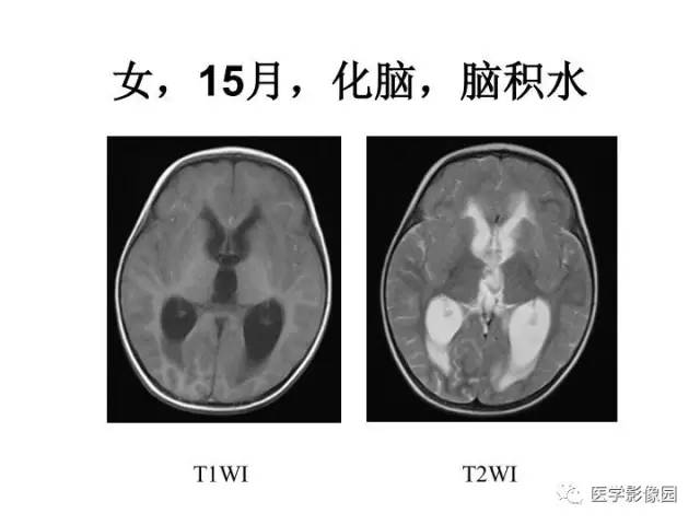【PPT】婴幼儿中枢神经感染的CT/MRI特征分析