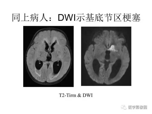 【PPT】婴幼儿中枢神经感染的CT/MRI特征分析