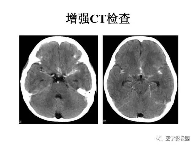 【PPT】婴幼儿中枢神经感染的CT/MRI特征分析