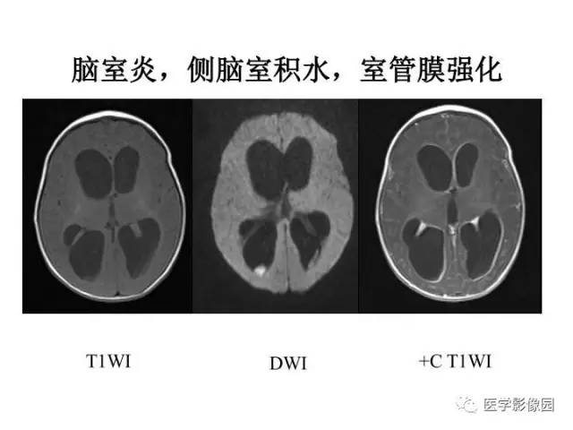 【PPT】婴幼儿中枢神经感染的CT/MRI特征分析