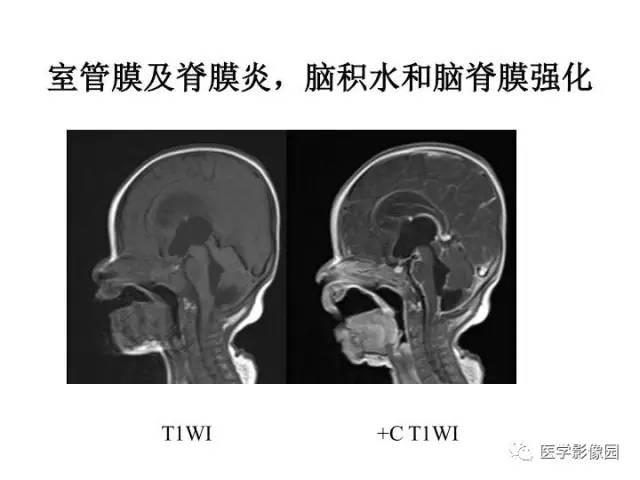 【PPT】婴幼儿中枢神经感染的CT/MRI特征分析