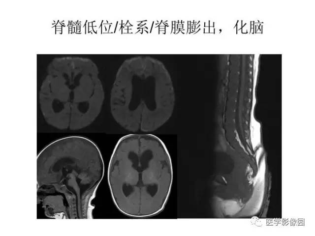 【PPT】婴幼儿中枢神经感染的CT/MRI特征分析