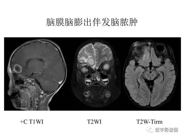 【PPT】婴幼儿中枢神经感染的CT/MRI特征分析