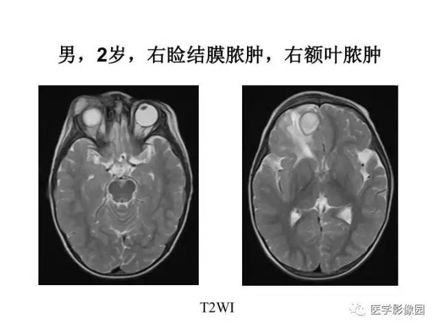 【PPT】婴幼儿中枢神经感染的CT/MRI特征分析
