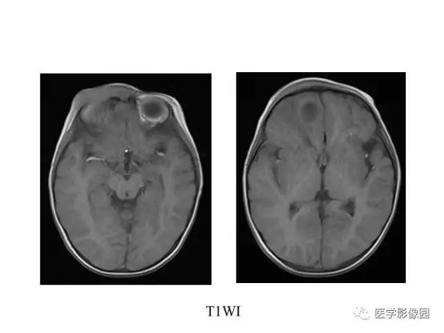 【PPT】婴幼儿中枢神经感染的CT/MRI特征分析