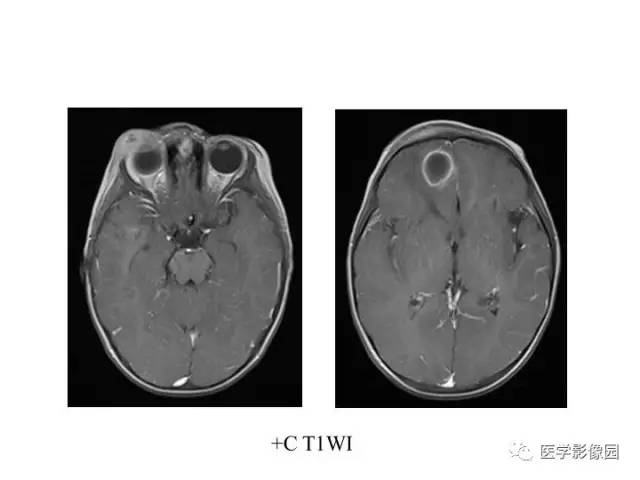 【PPT】婴幼儿中枢神经感染的CT/MRI特征分析