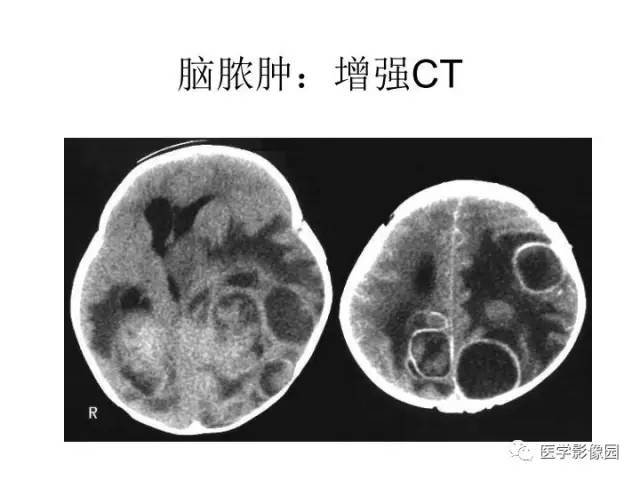 【PPT】婴幼儿中枢神经感染的CT/MRI特征分析