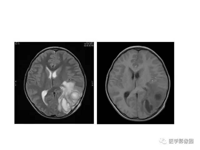 【PPT】婴幼儿中枢神经感染的CT/MRI特征分析