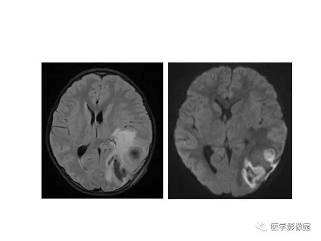 【PPT】婴幼儿中枢神经感染的CT/MRI特征分析
