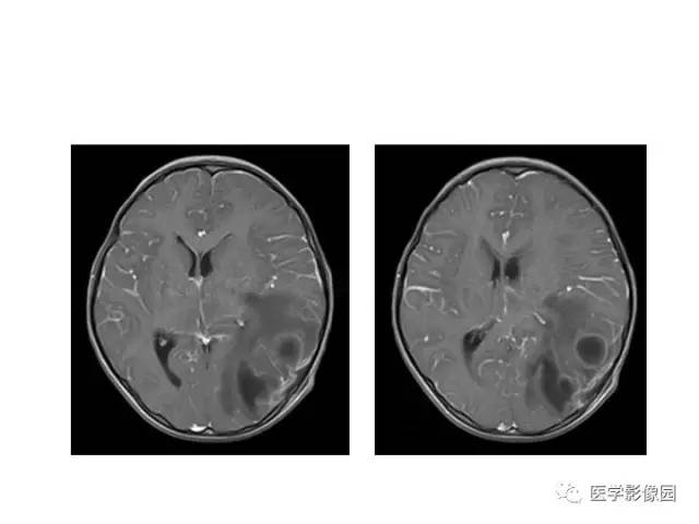 【PPT】婴幼儿中枢神经感染的CT/MRI特征分析