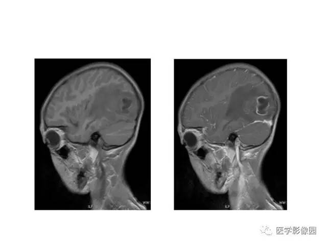 【PPT】婴幼儿中枢神经感染的CT/MRI特征分析