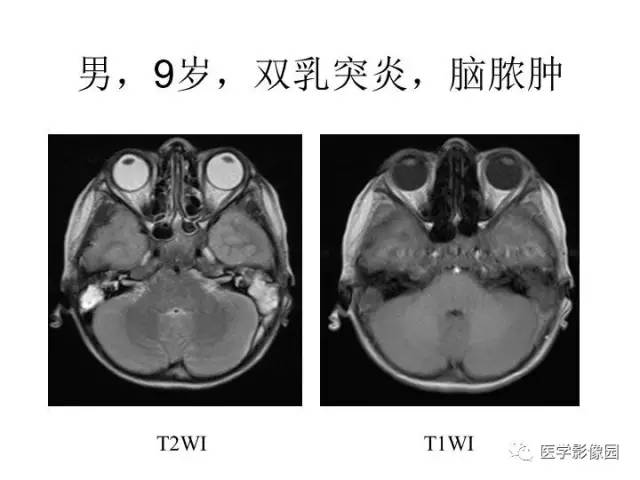 【PPT】婴幼儿中枢神经感染的CT/MRI特征分析
