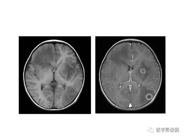 【PPT】婴幼儿中枢神经感染的CT/MRI特征分析