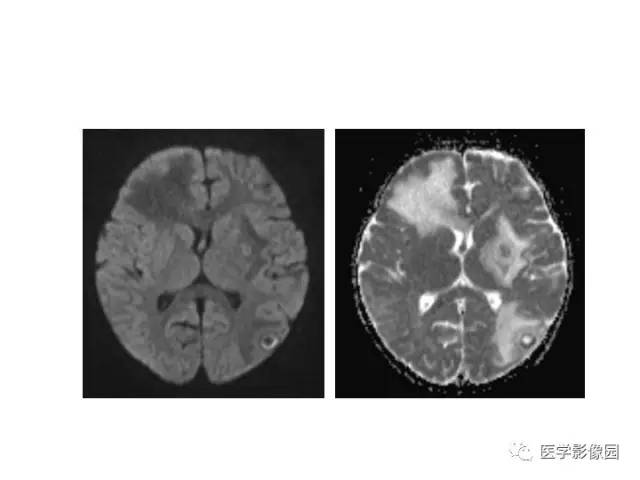 【PPT】婴幼儿中枢神经感染的CT/MRI特征分析
