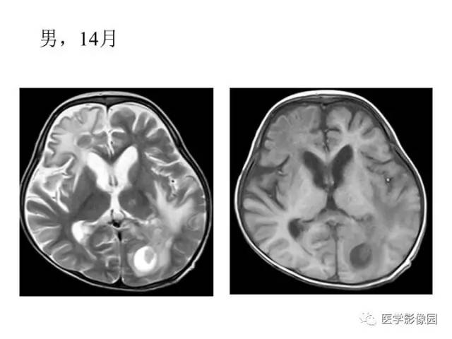 【PPT】婴幼儿中枢神经感染的CT/MRI特征分析