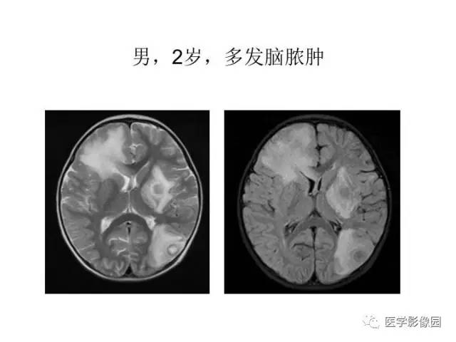 【PPT】婴幼儿中枢神经感染的CT/MRI特征分析