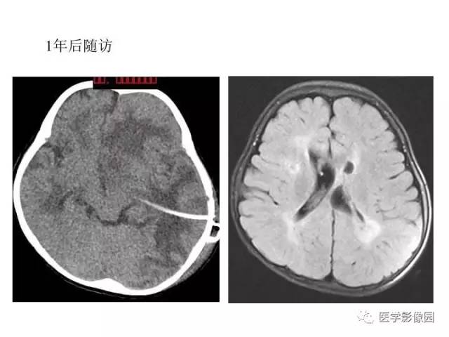 【PPT】婴幼儿中枢神经感染的CT/MRI特征分析