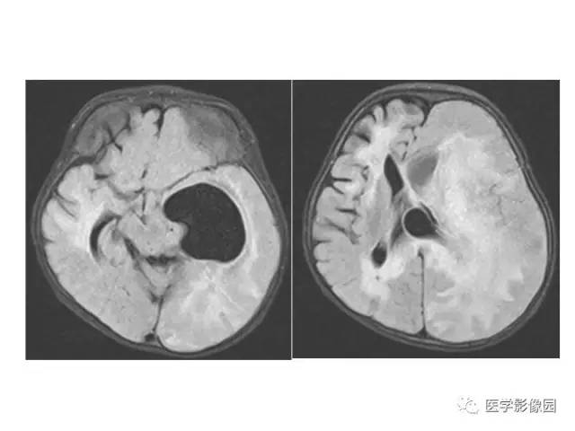 【PPT】婴幼儿中枢神经感染的CT/MRI特征分析