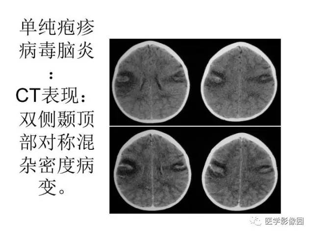 【PPT】婴幼儿中枢神经感染的CT/MRI特征分析