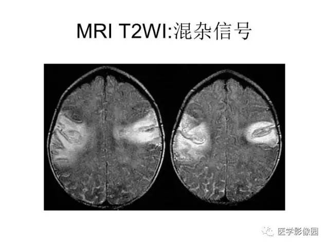 【PPT】婴幼儿中枢神经感染的CT/MRI特征分析