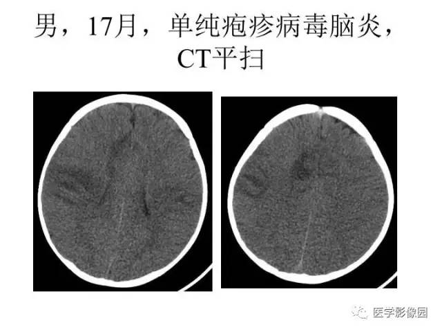 【PPT】婴幼儿中枢神经感染的CT/MRI特征分析