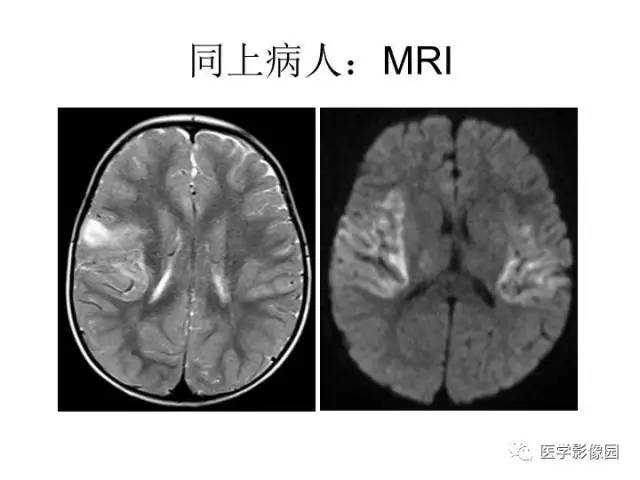 【PPT】婴幼儿中枢神经感染的CT/MRI特征分析