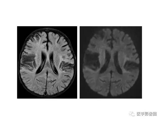 【PPT】婴幼儿中枢神经感染的CT/MRI特征分析