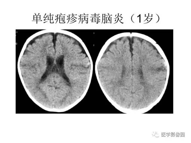 【PPT】婴幼儿中枢神经感染的CT/MRI特征分析