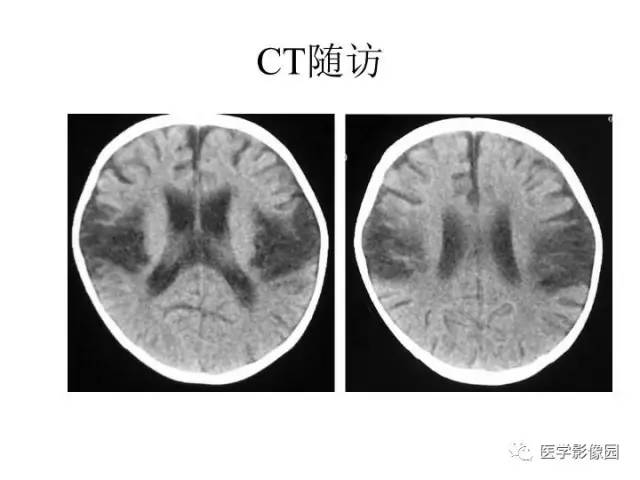 【PPT】婴幼儿中枢神经感染的CT/MRI特征分析