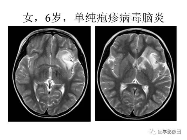 【PPT】婴幼儿中枢神经感染的CT/MRI特征分析