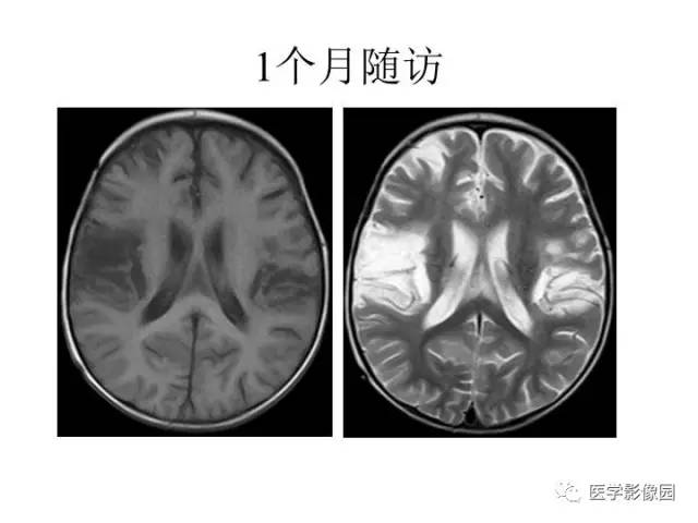 【PPT】婴幼儿中枢神经感染的CT/MRI特征分析