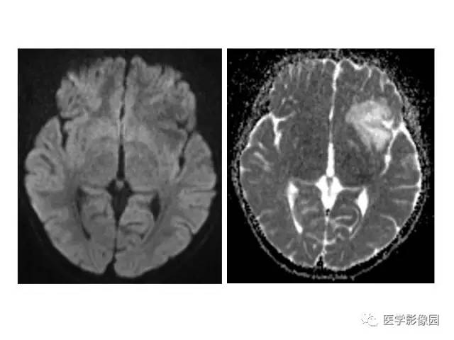 【PPT】婴幼儿中枢神经感染的CT/MRI特征分析