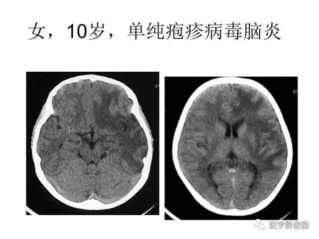 【PPT】婴幼儿中枢神经感染的CT/MRI特征分析